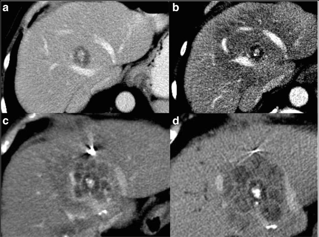 CT imaging example Progressive lesion 2015-10-30 NCAAPM