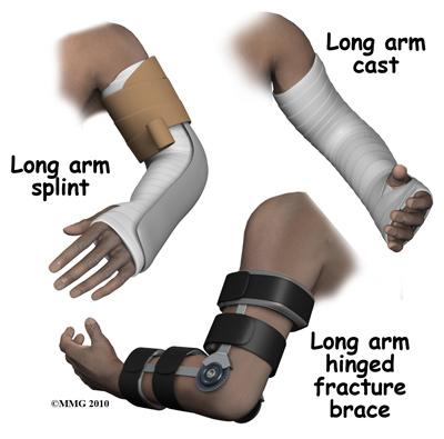 how your surgeon proposes fixing the fracture(s). The fracture is evaluated by taking several x-rays of the forearm that include the elbow joint and wrist joint.