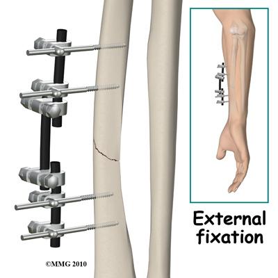 Most forearm fractures require Open Reduction and Internal Fixation (ORIF) using a metal plate and screws.