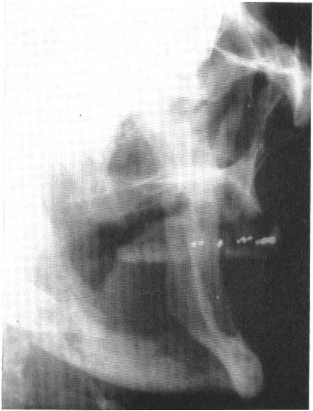 218 PARAPLEG IA fracture limb bones; thus, in the section on thoracic spinal wounds, 65 per cent. of casualties had a major associated injury (Barnett, J. c., Jr.).
