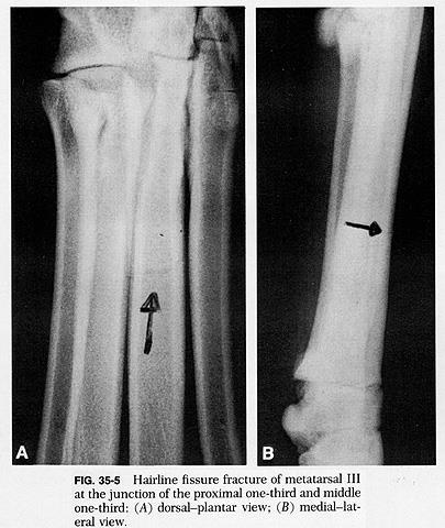 Hairline fracture of the 3 rd metatarsal