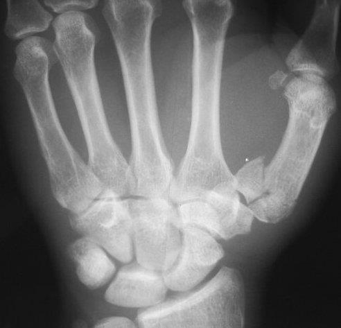 Comminuted of the first metacarpal (thumb!