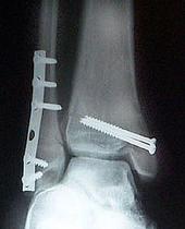 ? Also, appears to a fracture of distal tibia