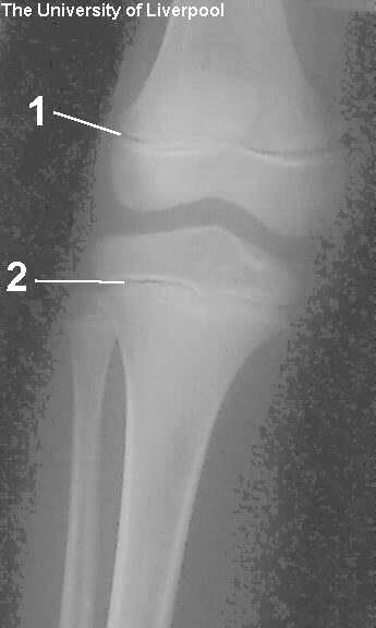 Reviewing: Epiphyseal Plates (younger skeletons) eventually will disappear.