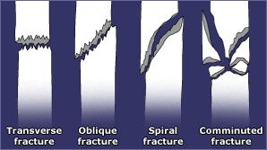 Shapes of Fractures A word may be used to describe the shape of the fracture eg.