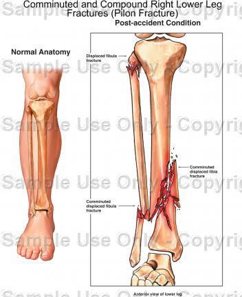 Comminuted Fractures - fibula is broken at both