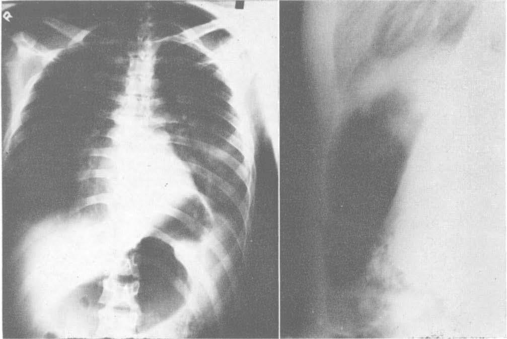 CASE REPORT: Diaphragmatic Rupture FIG. 3. Site of rupture of the diaphragm into the pericardial sac.