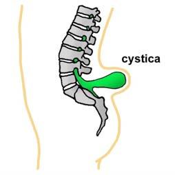 Spina Bifida (from L: split spine)