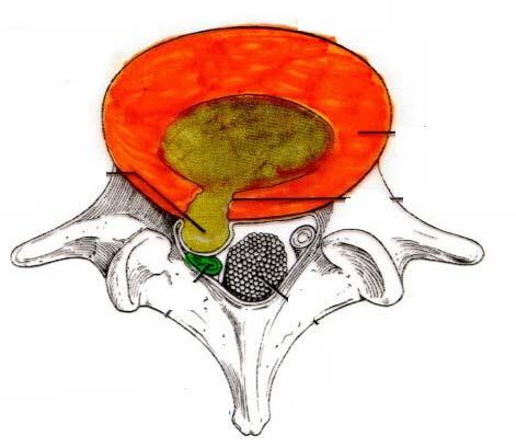 DAMAGE TO INTERVERTEBRAL DISC Postero-lateral lateral post SPINAL NERVE In older people.