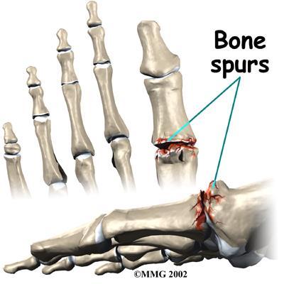 Bone Spurs Bony