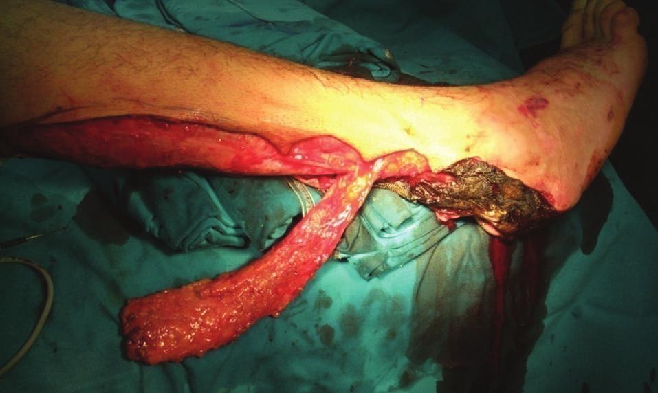 Failed plastic surgical reconstruction of the diabetic foot supply and its anatomic variations.