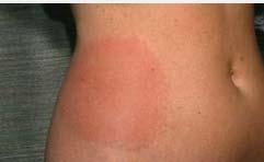 Definition Lyme disease is a bacterial infection caused by the spirochete Borrelia burgdorferi (B. burgdorferi) in the US and Borrelia afzelii (B. afzelii) and Borrelia garinii (B.