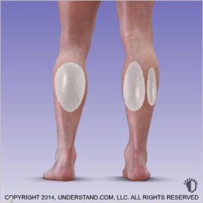 Calf Implant Options Calf implants improve contours or accentuate muscular volume.
