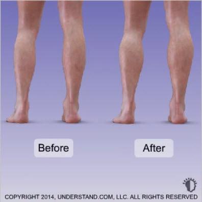 Calf Implant Recovery & Results Your physician may request that you wear compression stockings for a couple of weeks.