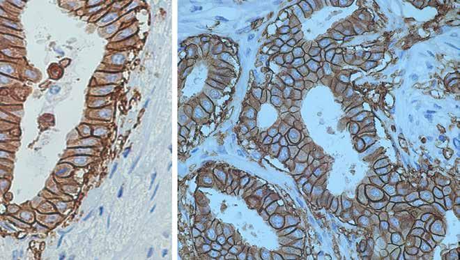 B) Serial section from same normal breast after immunohistochemical staining for HER2 protein at higher magnification showing lateral and basal membranes with HER2 protein by IHC and lumen membrane