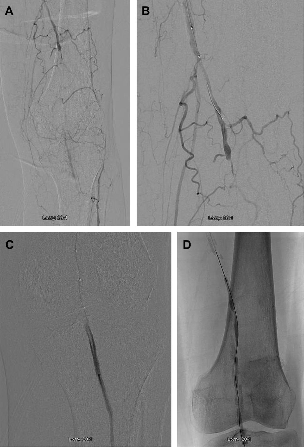 532 Schneider et al August 2013 Fig 3. Re-entry in a calcified artery. A, The patient has a distal superficial femoral and proximal popliteal occlusion with reconstitution at the knee.