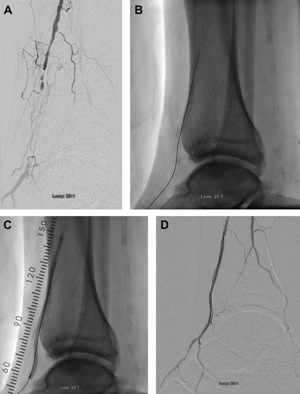 B, The wire passage is accomplished through the needle and into the true lumen. In this case, the re-entry site into the true lumen is proximal to a calcified above-the-knee popliteal artery stenosis.
