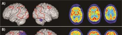 to a resting state Increased prefrontal
