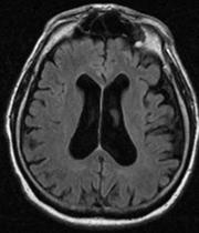 Test Results Labs (done subsequently): TSH/B12 normal MRI (done