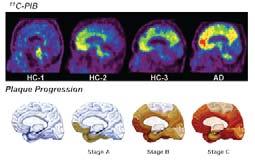 Preclinical AD Amyloid Imaging in The AIBL Study 60 Prevalence of PiB+ve PET in HC Prevalence (%) 50 40 30 20 10 Prevalence of plaques in HC (Davies, 1988, n=110) (Braak, 1996, n=551) (Sugihara,