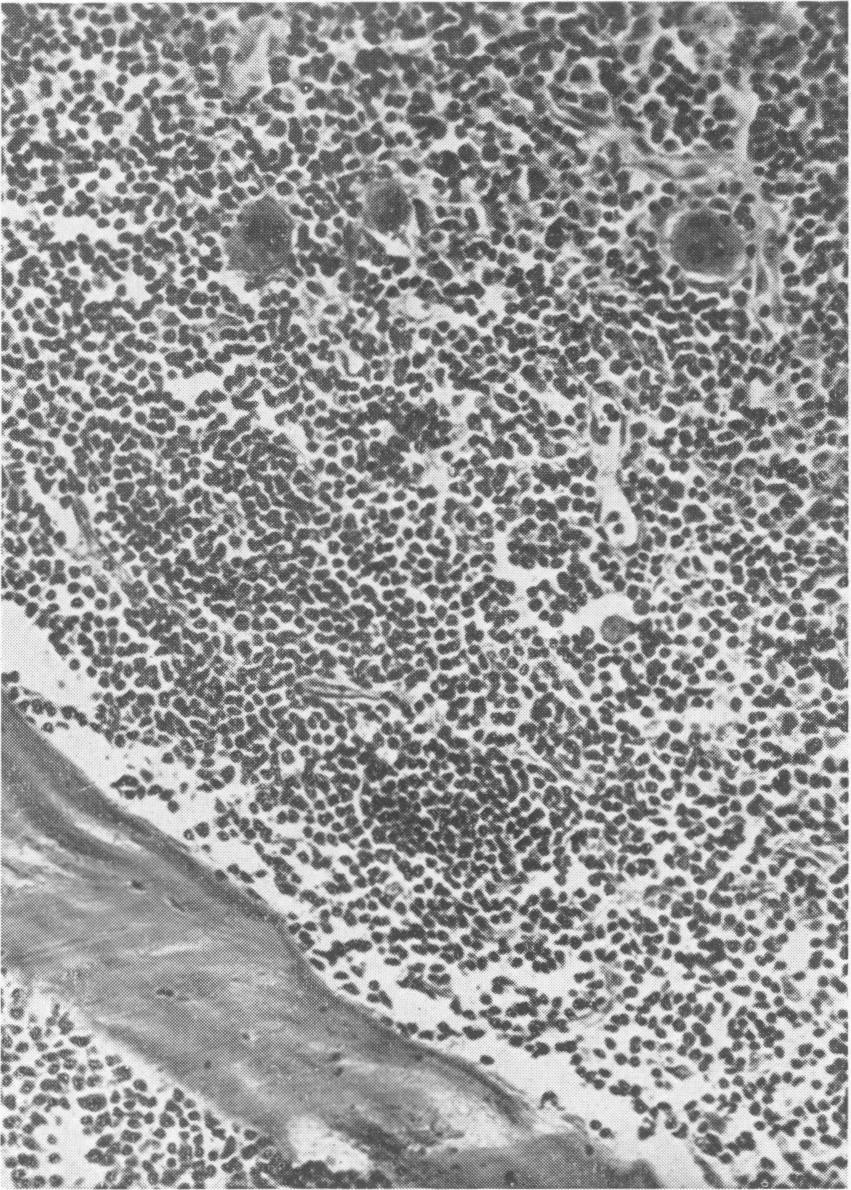 kllgi:f:i.jj.: FIG. 7.-Megakaryocytes in various stages of maturation, those with pleomorphic nuclei forming platelets.
