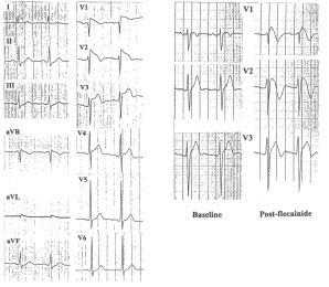 Brugada syndrome in Chinese patients the characteristic coved-type, and less commonly saddlebacktype, ST-segment elevation in leads V to V 3 on an electrocardiogram (ECG) recorded during sinus rhythm