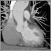 Marfan ssyndrome (Video) Aortic root dilation: rupture - cause death Assess and follow on ECHO B blockers Low intensity sports May need aortic +/- mitral valve replacement Marfan ssyndrome (Video)