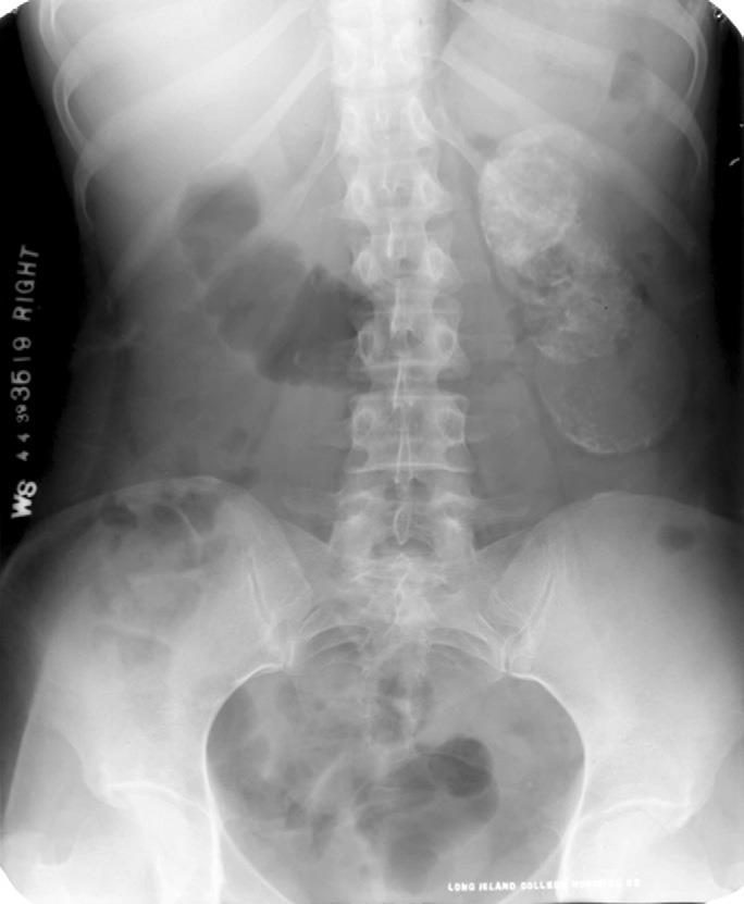 investigations KUB: Findings include renal calcification (cement kidney) IVU: irregular calyces, hydronephrosis caused by stricture of the