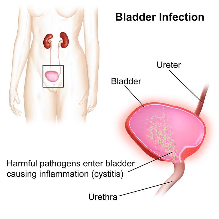 Cystitis Burning when urinating Frequent urination Urge to urinate Pain above the pelvic bone Rare traces of blood
