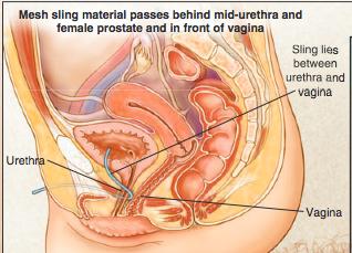 Sexual Side Aspects of Incontinence - Suburethral Sling Surgery - in Women: Orgasm types i) clitoral - rhythmic contractions of the vagina activated by