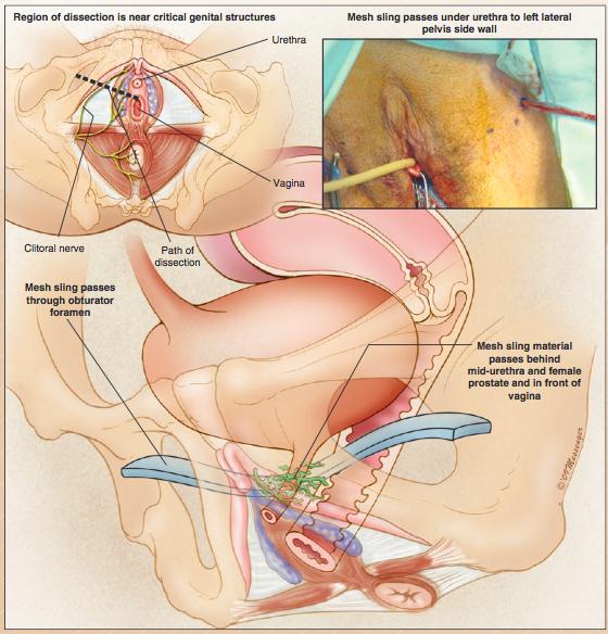 Sexual Side Aspects of Incontinence - Suburethral Sling Surgery - in Women: Orgasm types i) clitoral - rhythmic contractions of the vagina activated by clitoral stimulation ii) vaginal - rhythmic