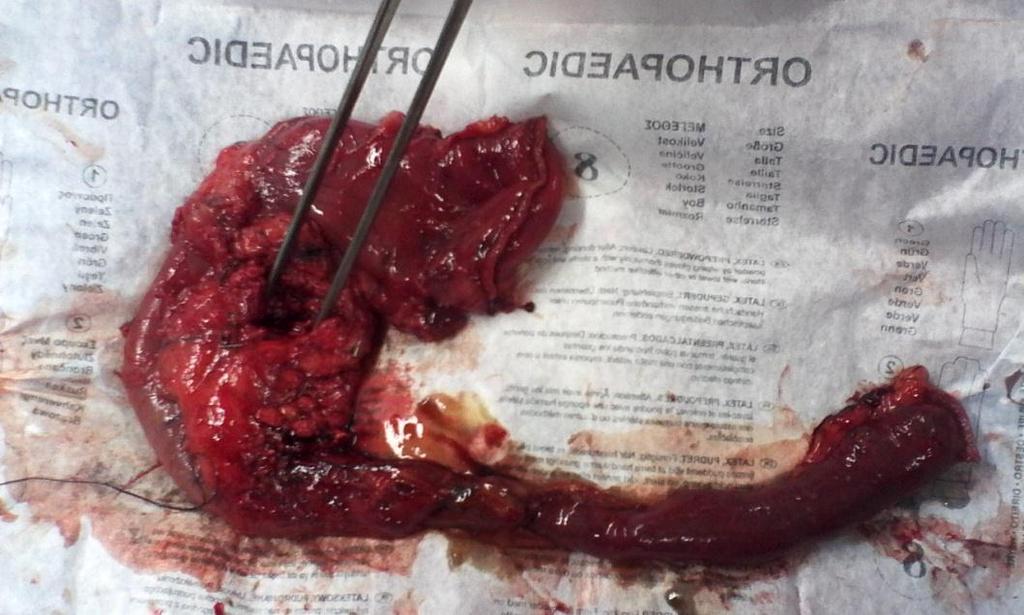 Figure 51: pancreaticodudenectomy specimen. Case 13: Female patient 58 years old.