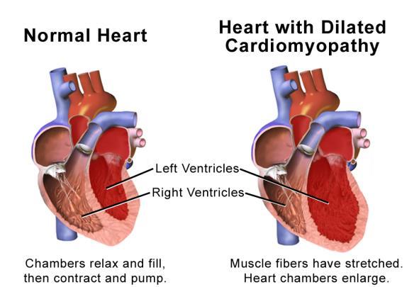 Alcoholic Cardiomyopathy Heavy drinking weakens the heart muscle, which means the heart can t pump blood as
