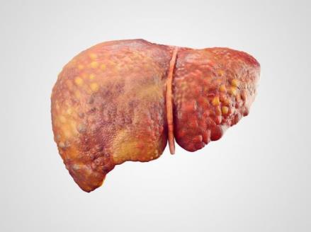 by fat deposition in liver cells, inflammation and mild scarring