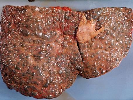 Medical Problems Associated with Alcohol Use Liver disease Cirrhosis -