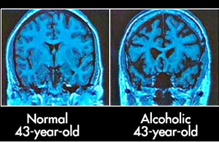 Medical Problems Associated with Alcohol Use Heavy alcohol consumption directly damages brain cells. The more alcohol one consumes, the more of the brain s white matter is lost.