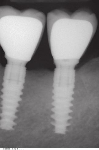 2 mm thread spacing with double-lead thread pattern; this means that the implants advance 2.4 mm with each rotation of the implant.