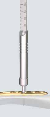 3 Insert LCP locking screw Screwdriver Shaft, hex, small, 2.5 mm 314.030 Screwdriver Shaft Stardrive 3.5 T15 314.116 Handle for Torque Limiter 1.5 Nm (511.770/511.