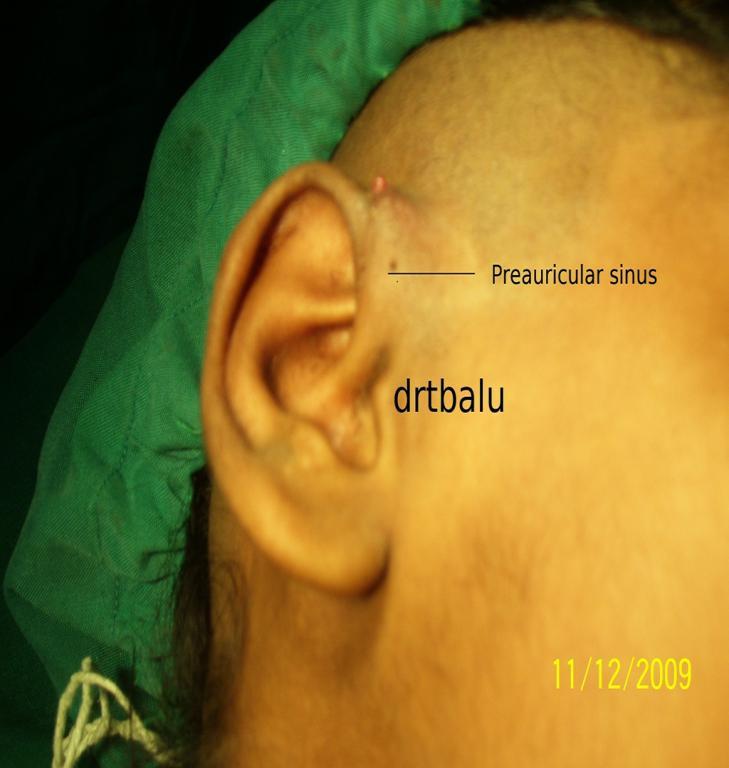 1 OTOLARYNGOLOGY ONLINE Preauricular sinus Management Dr. T. Balasubramanian 6/17/2010 This e book discusses the Etiopathogenesis of preauricular sinus.