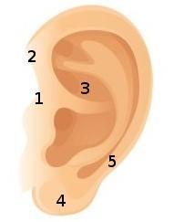Figure showing the common sites of preauricular sinus involvement. 1. Anterior margin of ascending limb of helix (most common) 2. Superior to auricle 3. Along the posterior surface of cymba concha 4.