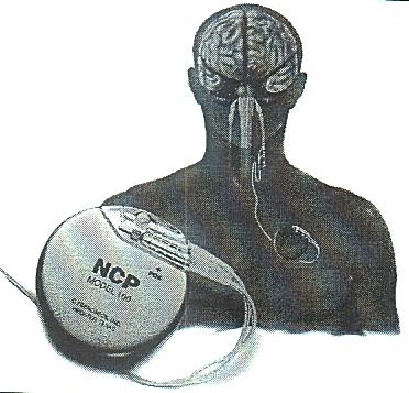 Vagus Nerve Stimulator l l l l l Device implanted just under the skin in the chest with wires that attach to the vagus nerve in the neck Delivers intermittent electrical stimulation to the vagus