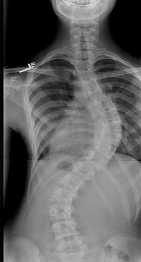 Scope and Incidence Scoliosis is spinal asymmetry in the coronal plane not a specific disease, rather a family of similar diseases. 4-14% of all kids have some degree of measurable spinal asymmetry.