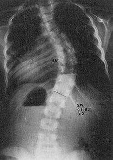 Types of scoliosis Non-pathologic spinal asymmetry