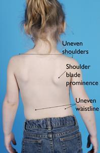 Congenital Scoliosis Scoliosis at birth due to structural defects.