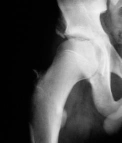 1958] [Suh PB Spine 1988] triradiate cartilage closed =