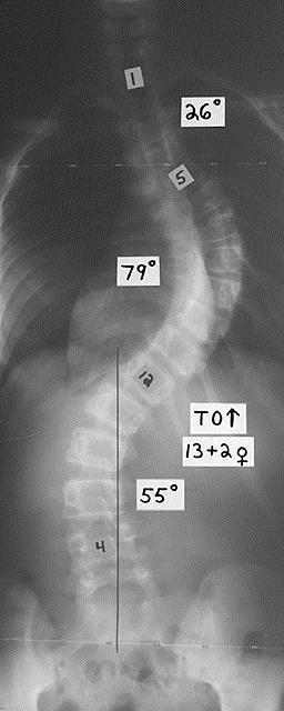 Causes of Scoliosis Congenital