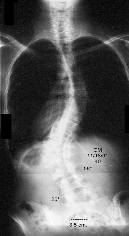 Adult Scoliosis Impact of Spinal Deformity Absolute magnitude