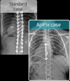 Apifix Surgical incision approx.