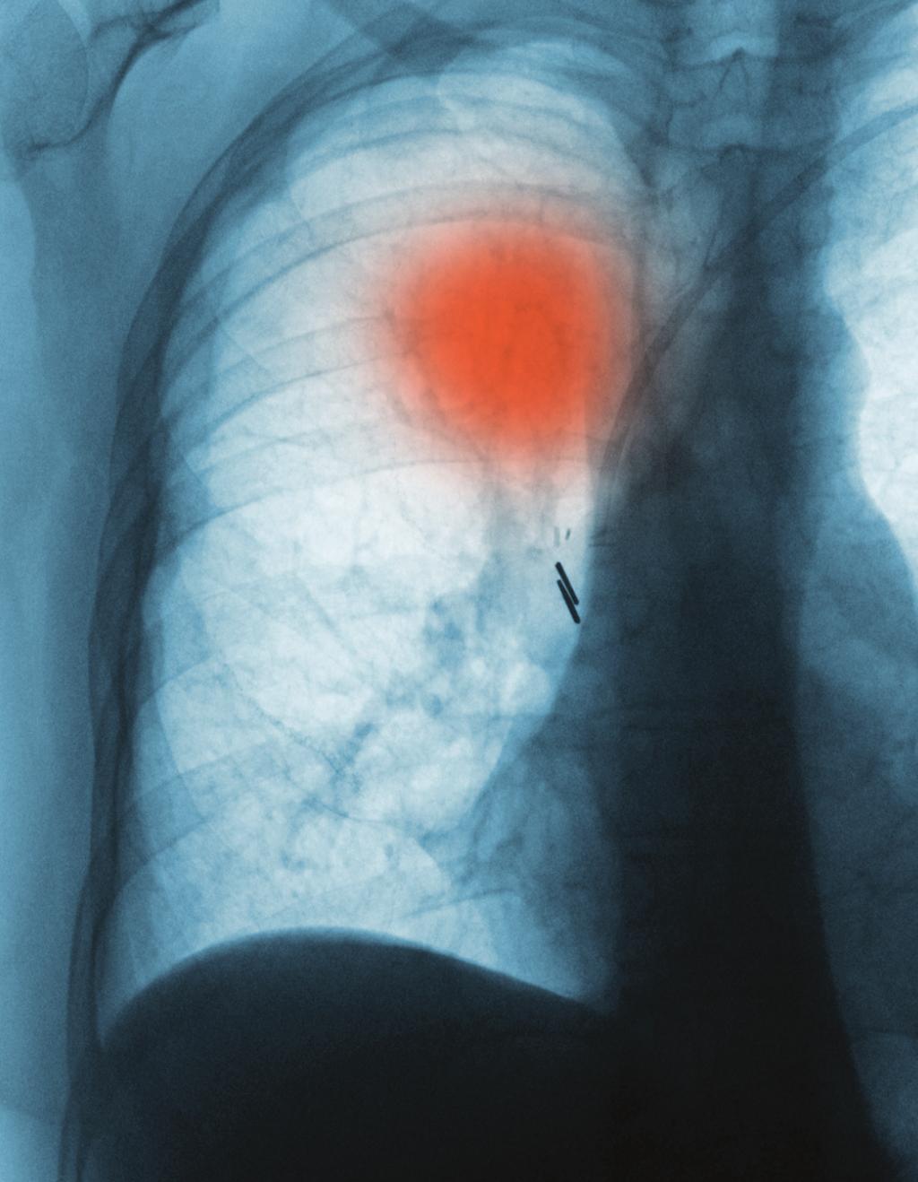 continuing education educational objectives After participating in this activity, clinicians should be better able to Perform diagnostic/molecular testing (EGFR, KRAS, EML4-ALK) for NSCLC according