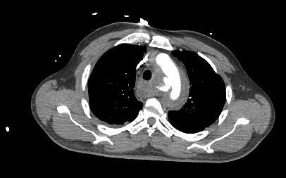 pseudoaneurysm with concurrent increase in external contour of the aorta but without extravasation of intravenous contrast Full-thickness aortic injury